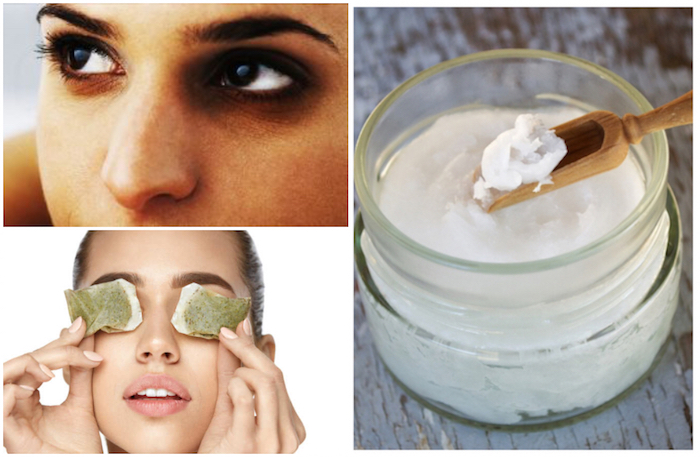 14 Dwelling Treatments to Get Rid of Darkish Eyelids
