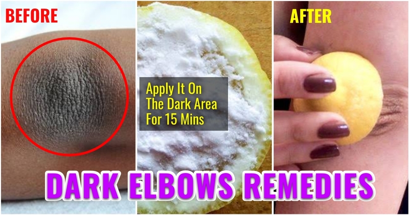 5 Do-it-yourself Cures For Melasma and Darkish Spots